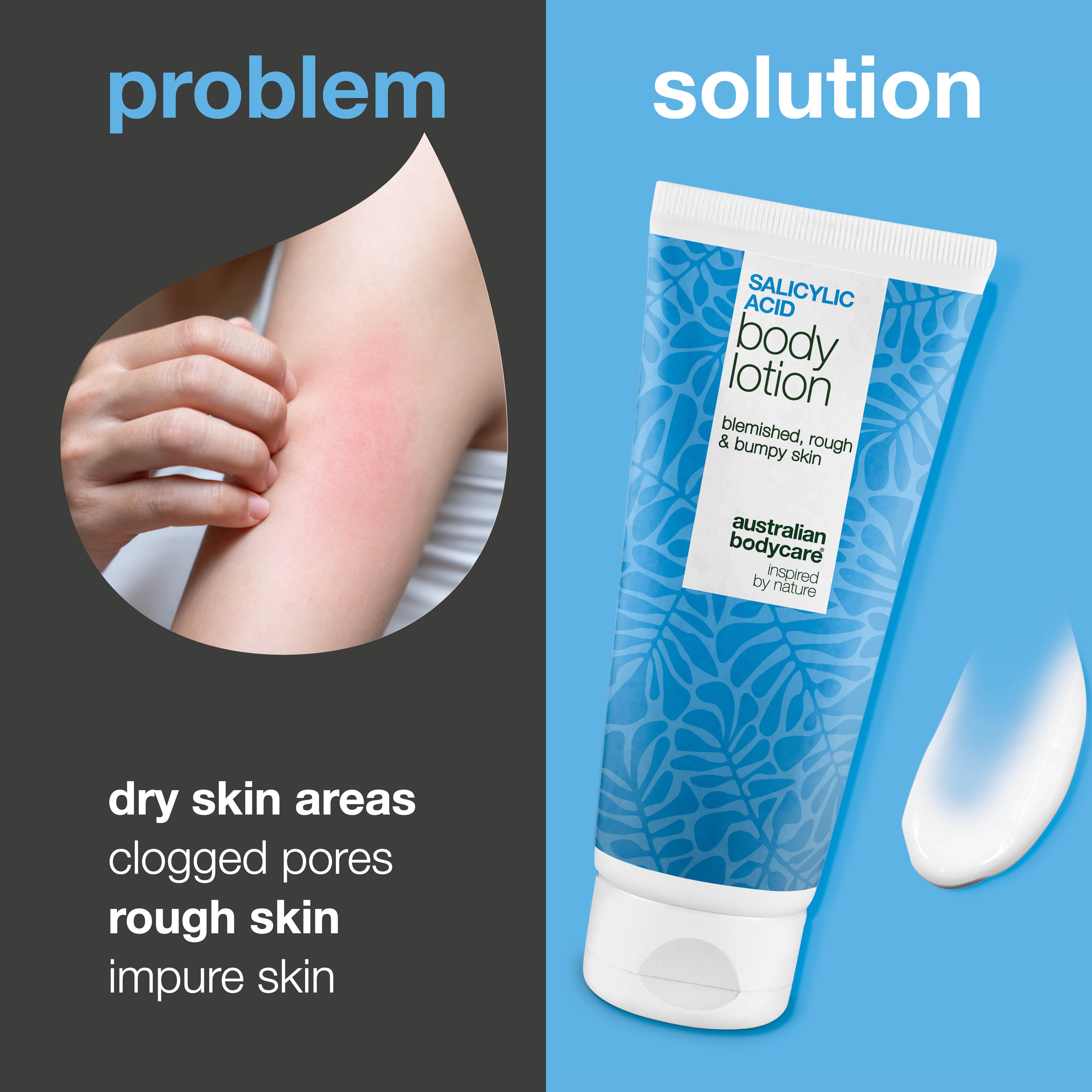 Vartalovoide salisyylihapolla – kuivalle ja karhealle iholle — Vartalovoide salisyylihapolla kuorii, kosteuttaa ja pehmentää kuivaa ja karheaa ihoa. Täydellinen päivittäiseen käyttöön.