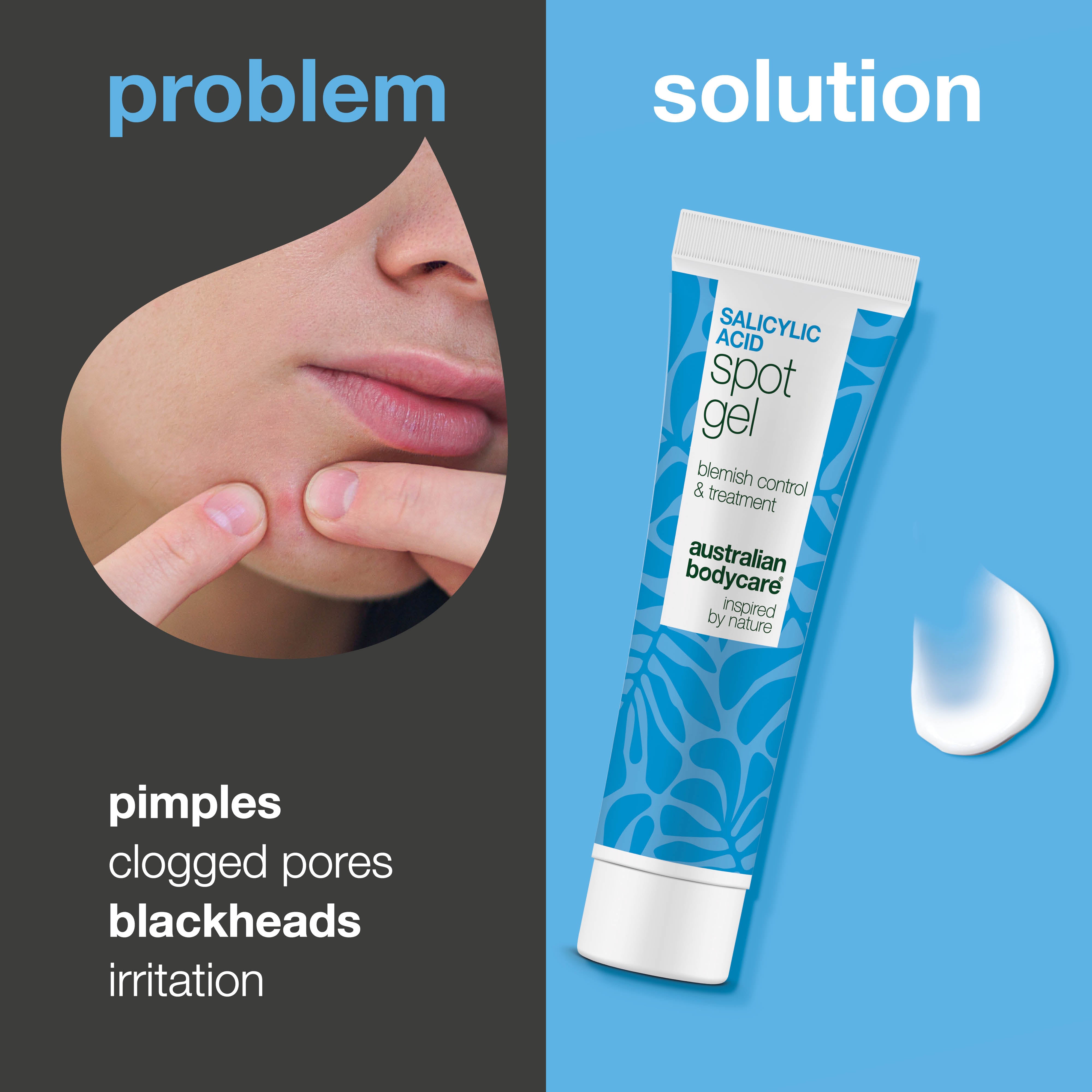 Salisyylihappo Spot Gel näpyille, mustapäille ja punoitukselle – puhdistaa huokoset ja rauhoittaa ihoa