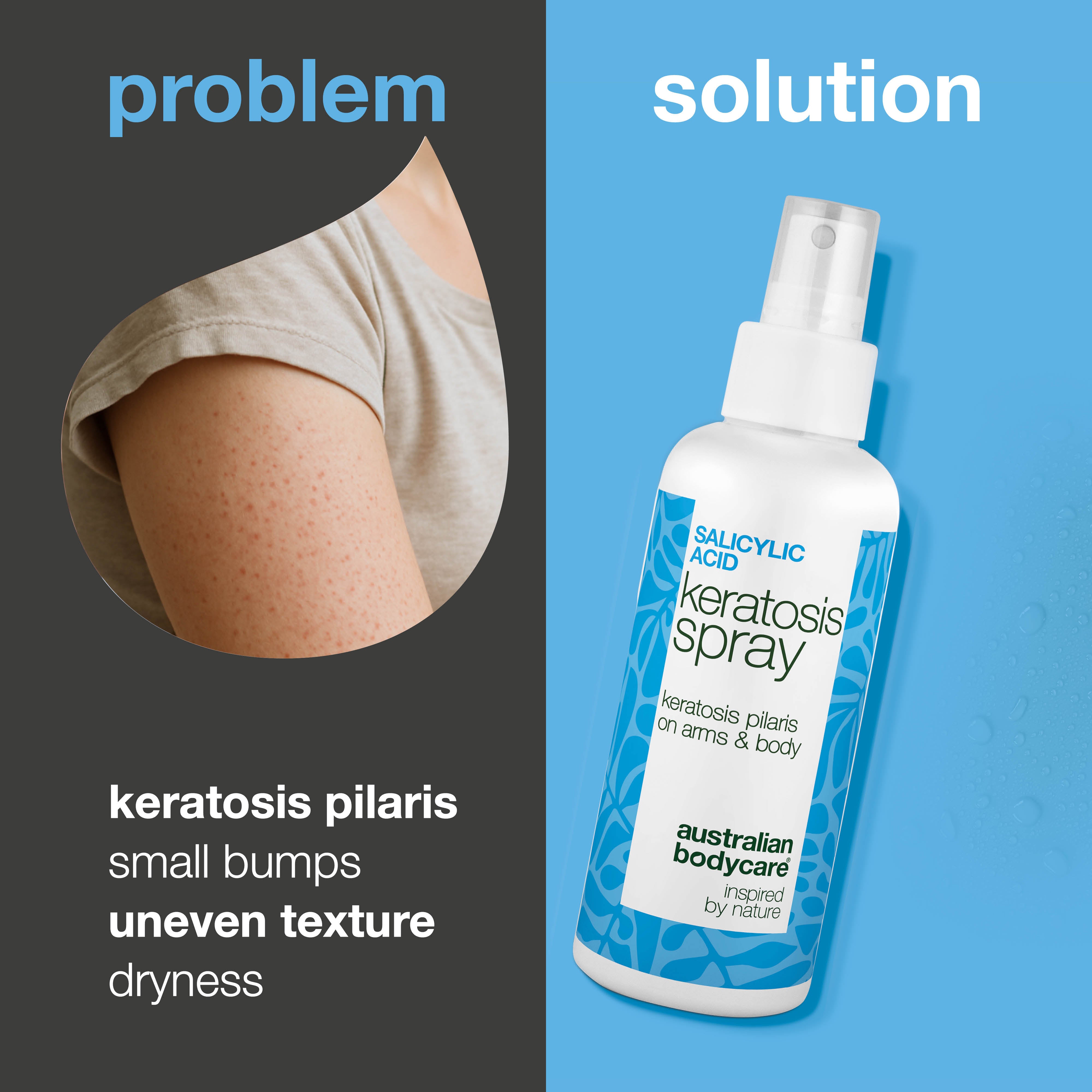 Suihke keratosis pilarikseen ja karhealle kananliha-iholle — Keratosis pilaris -suihke tasoittaa karhean ihon ja vähentää näppyjä. Sisältää salisyylihappoa, joka puhdistaa ja kuorii.