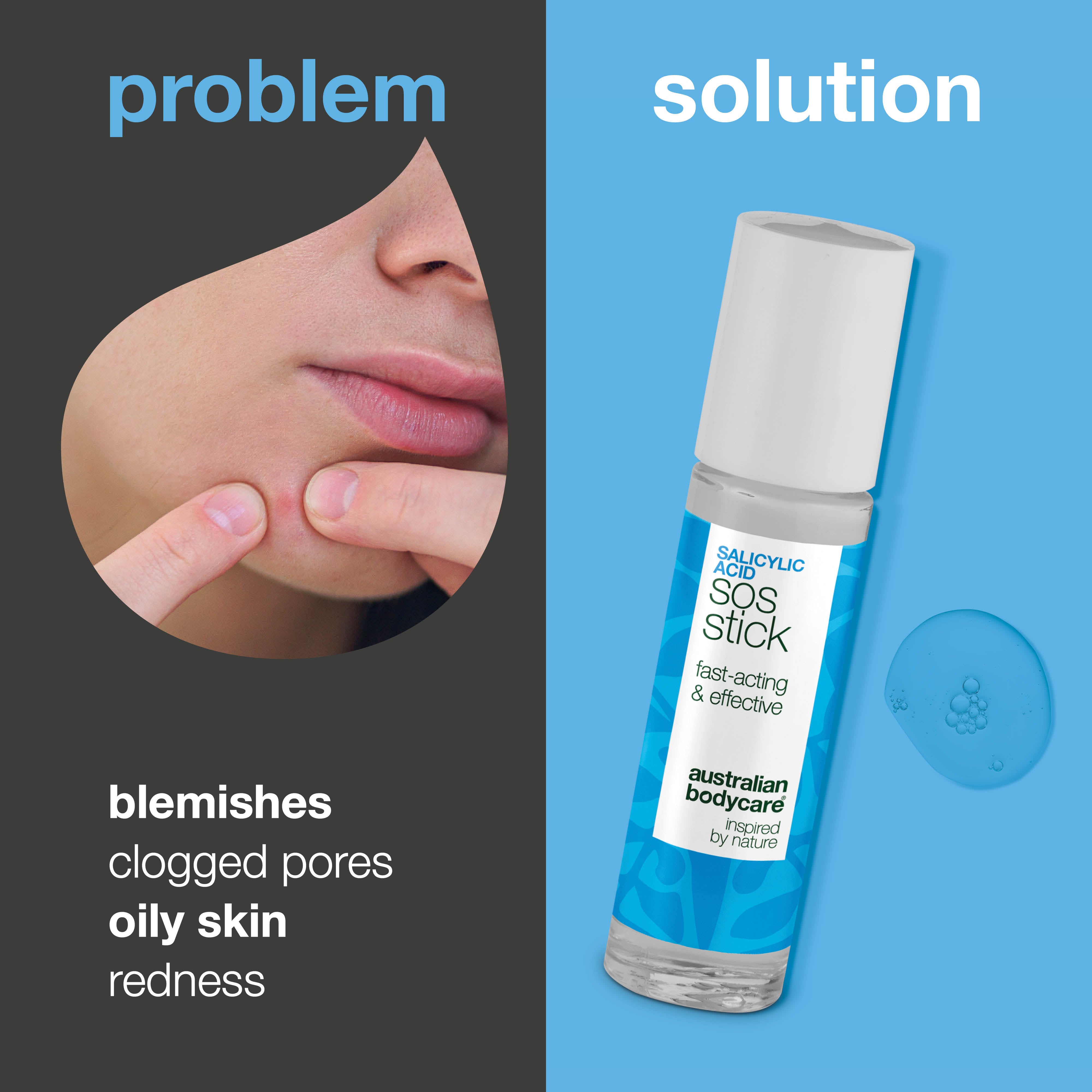 SOS-tikku salisyylihapolla – vähentää näppyjä ja punoitusta, puhdistaa ihohuokoset nopeasti