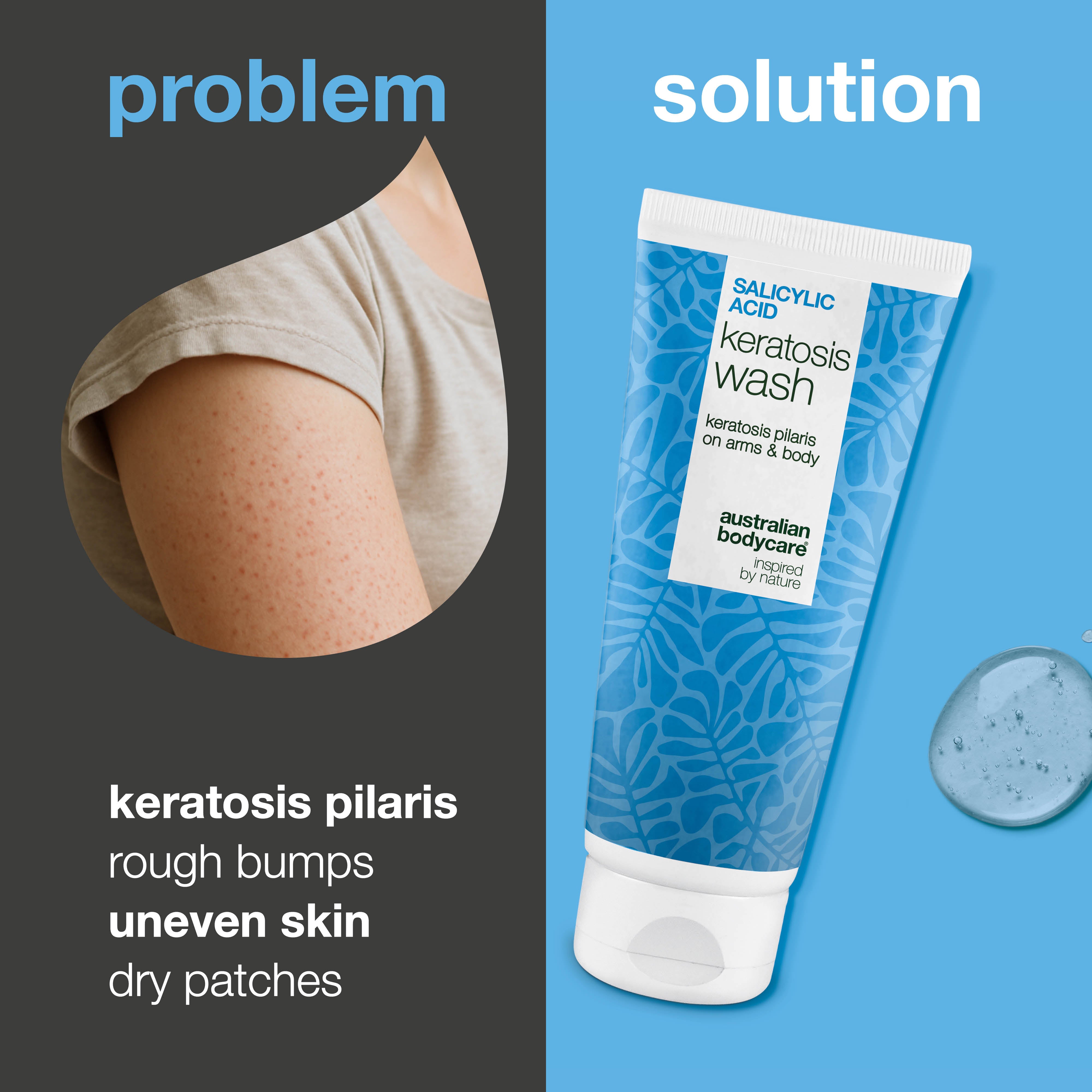 Keratosis Pilaris Body Wash keratoosi pilaris -iholle, tukkeutuneille huokosille ja punoitukselle. Salisyylihappo, niasiiniamidi, sinkki PCA ja E-vitamiini.