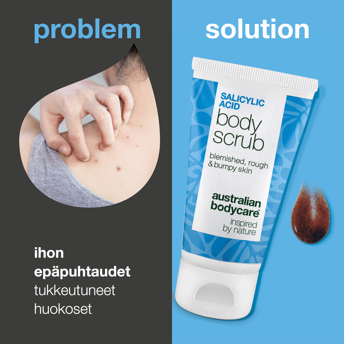 Ongelma ja ratkaisu: näppylät vartalolla, tukkeutuneet huokoset ja epätasainen iho. Vasemmalla lähikuva olkapäästä, jossa on näppylöitä, oikealla Australian Bodycaren Salicylic Acid Body Scrub