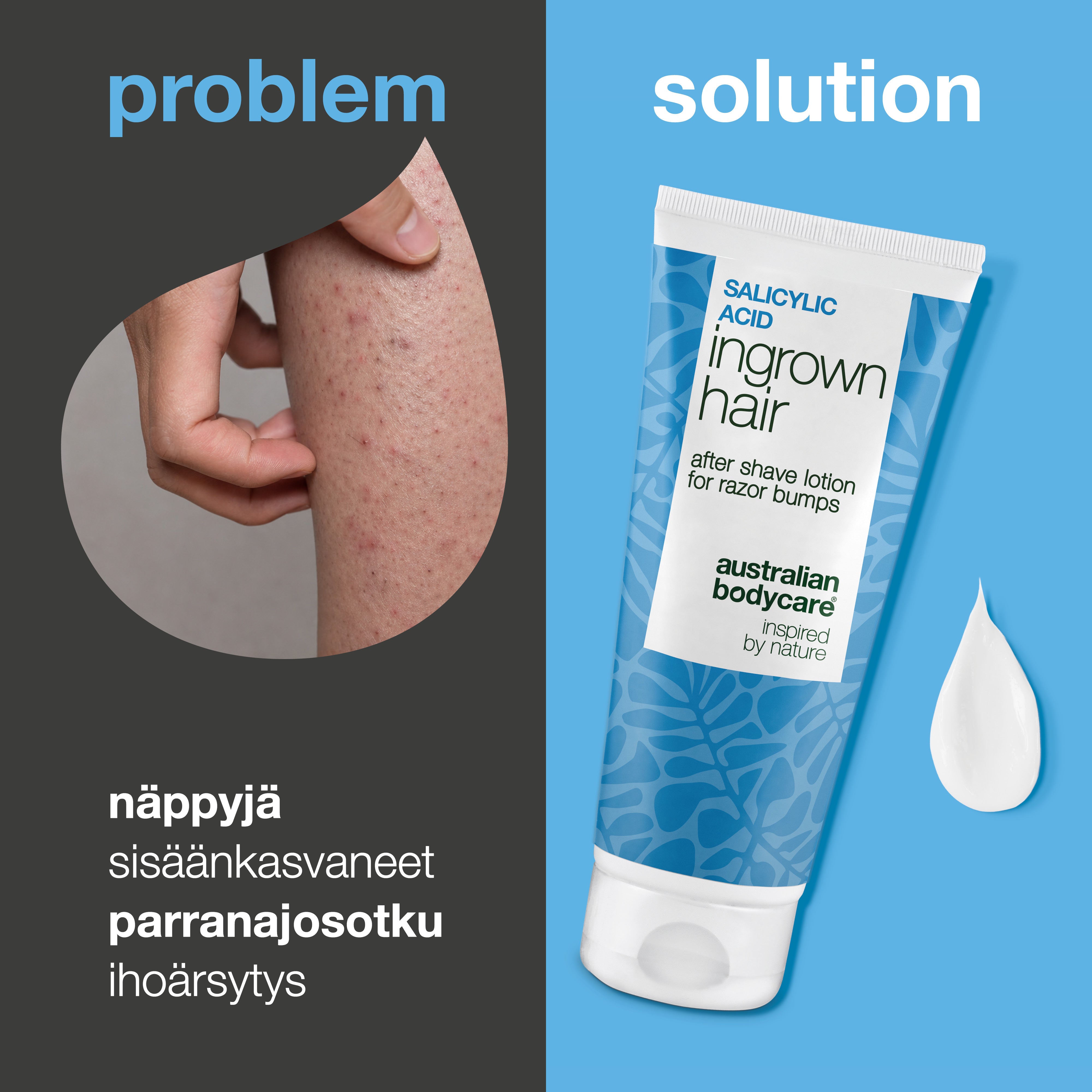 Salisyylihappoa sisältävä After Shave Lotion sisäänkasvaneille karvoille, punaisille näpyille ja ajon jälkeiseen ihoärsytykseen. Tuote näkyy kuvassa ihon vieressä, jossa on näkyviä punaisia näppyjä ja sisäänkasvaneita karvoja.