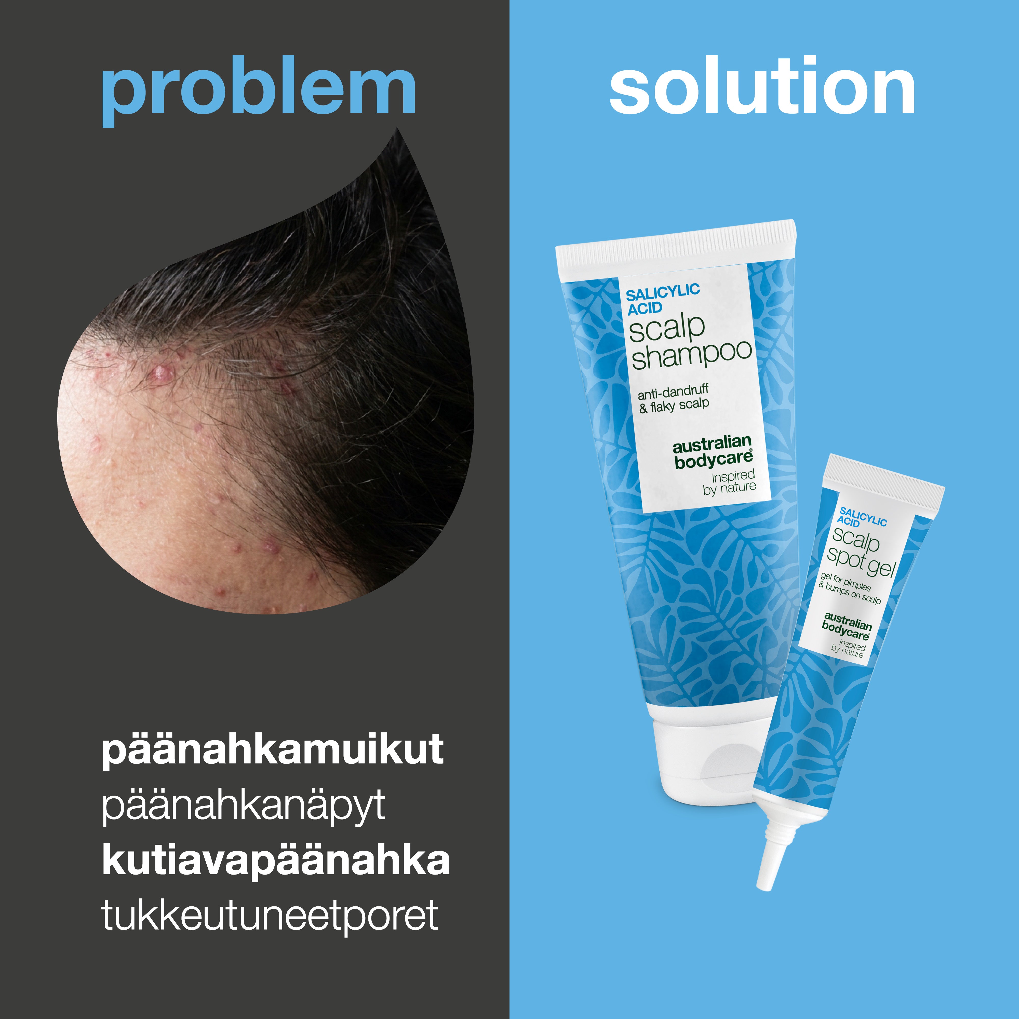 Ongelma ja ratkaisu: lähikuva näppylöistä ja kuhmuista päänahassa sekä setin shampoo ja täsmägeeli