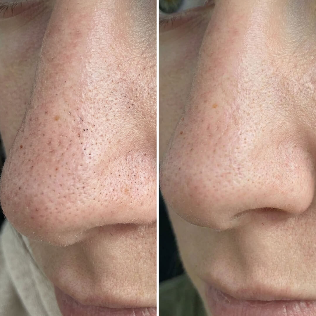 Paketti mustapäille ja tukkeutuneille ihohuokosille salisyylihapolla – syväpuhdistava hoitorutiini