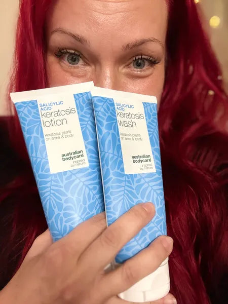 Asiakkaan tulos keratosis pilaris – Viktorija K.