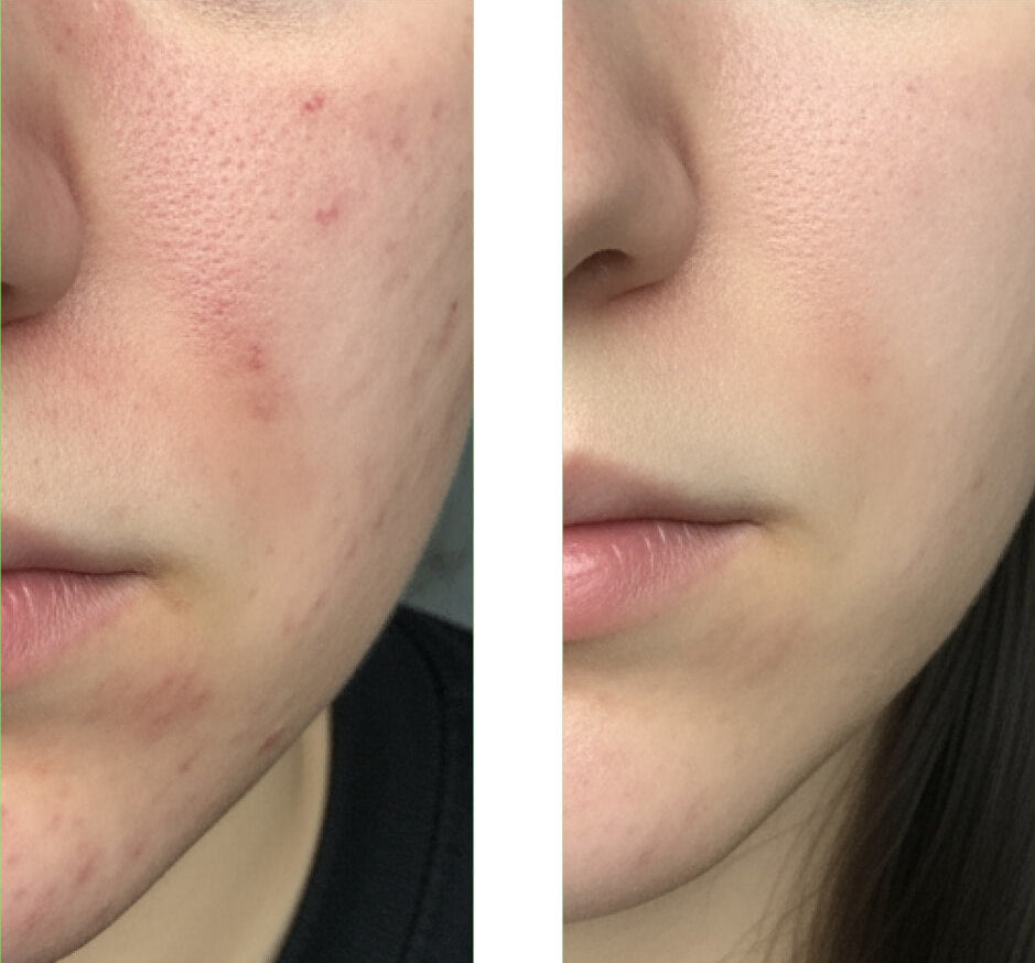 Ennen ja jälkeen -kuva asiakkaasta käyttämässä Salicylic Acid Cleanser -puhdistusainettamme, jossa näkyy suuri parannus ihossa sekä vähemmän finnejä ja epäpuhtauksia.