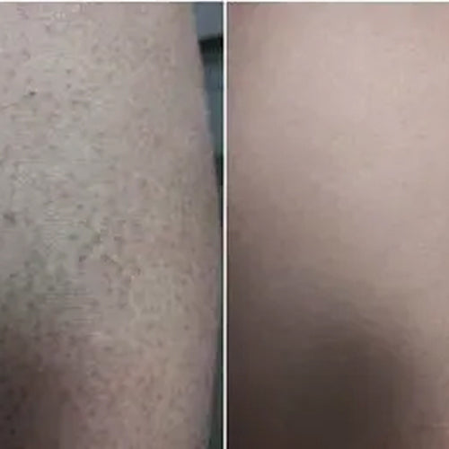 Alenan tulos 2 viikon jälkeen keratosis pilaris -hoitopaketilla