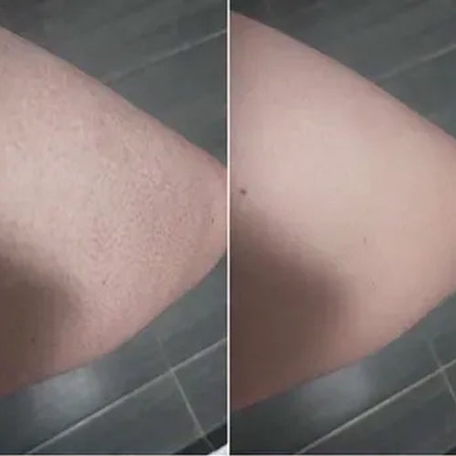 Keratosis pilaris ennen ja jälkeen – Alenan sileämpi iho 2 viikon jälkeen