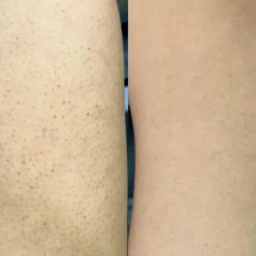 Isabellin tulos keratosis pilaris -hoitopaketilla – vähemmän näppylöitä reisissä