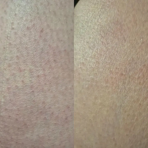 Lähikuva ihosta keratosis pilaris -hoidon jälkeen – Carolinin tulos