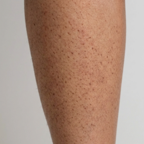 Lähikuva keratosis pilariksesta – pieniä karheita näppylöitä käsivarsissa