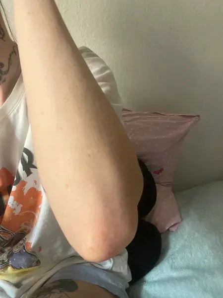 Asiakkaan tulos keratosis pilaris – Lisa A.