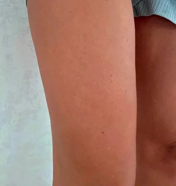 Asiakkaan tulos keratosis pilaris – Sarah S.