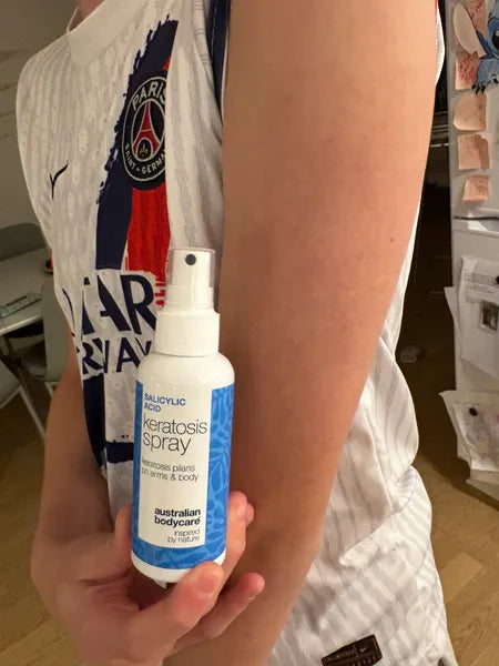 Asiakkaan tulos keratosis pilaris – 70% vähennys näppylöissä 3 viikon jälkeen